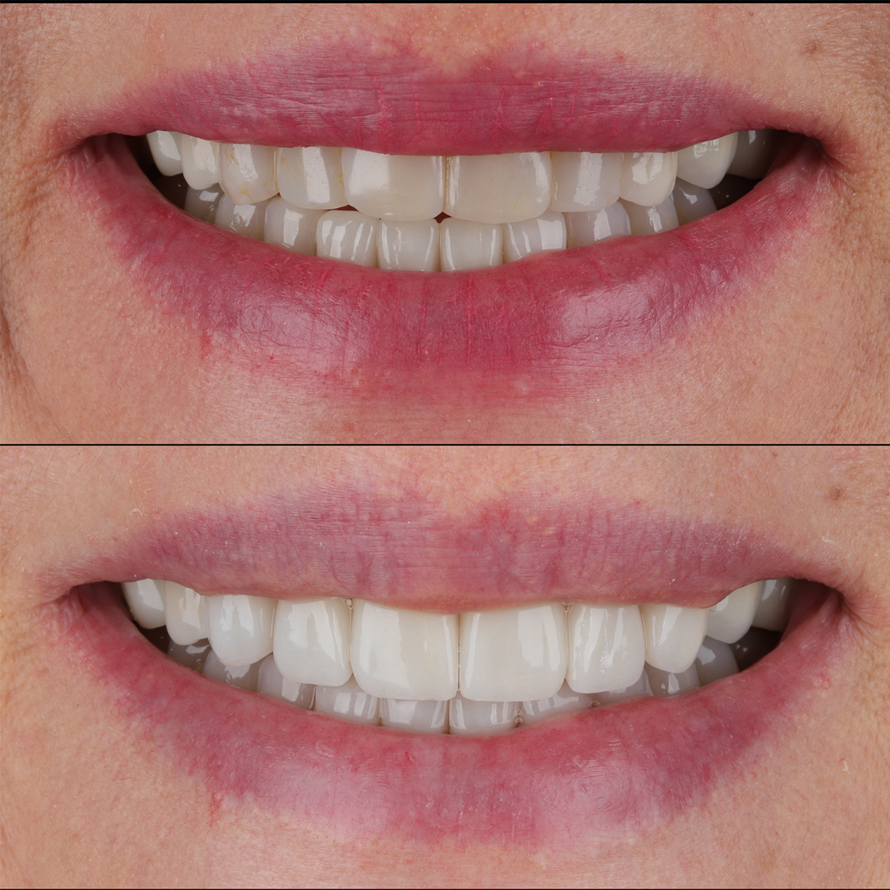 Porcelain Veneers