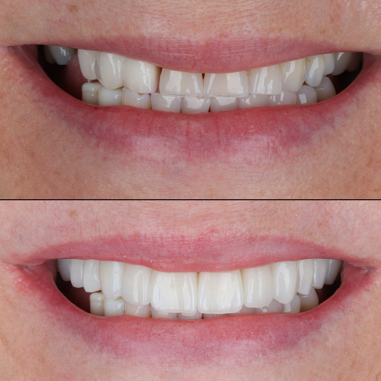 Porcelain Veneers