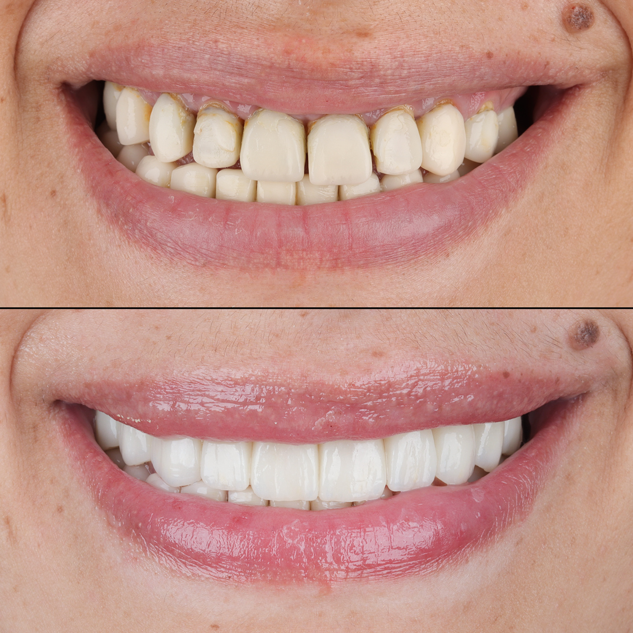 Porcelain Veneers